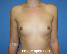 plastic-surgery-breast-augmentation